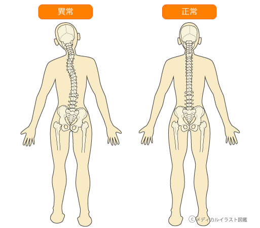 歪み