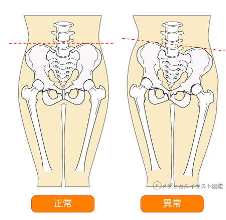 骨盤矯正